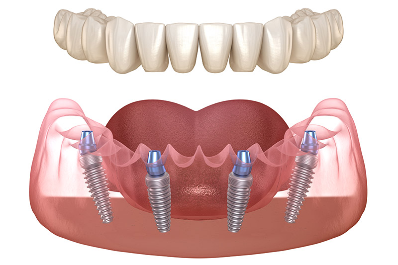 all on 4 dental implants