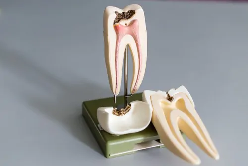 root canal