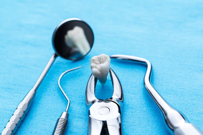 dental extraction