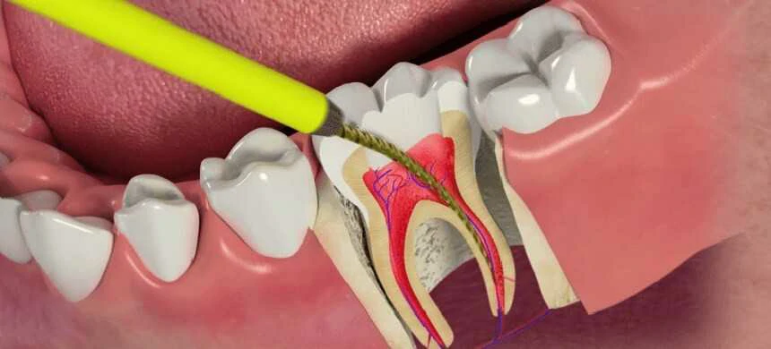 root canal